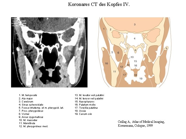 Koronares CT des Kopfes IV. 1. M. temporalis 2. Ala major 3. Cerebrum 4.