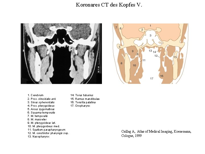 Koronares CT des Kopfes V. 1. Cerebrum 2. Proc. clinoidalis ant. 3. Sinus sphenoidalis