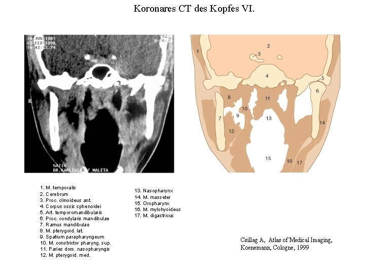 Koronares CT des Kopfes VI. 1. M. temporalis 2. Cerebrum 3. Proc. clinoideus ant.