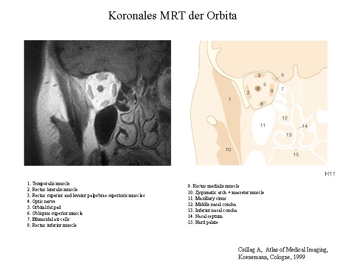 Koronales MRT der Orbita 1. Temporalis muscle 2. Rectus lateralis muscle 3. Rectus superior