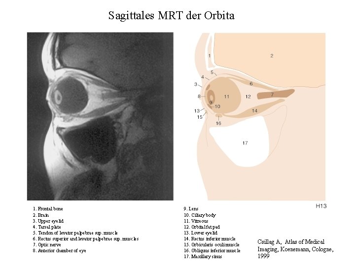 Sagittales MRT der Orbita 1. Frontal bone 2. Brain 3. Upper eyelid 4. Tarsal