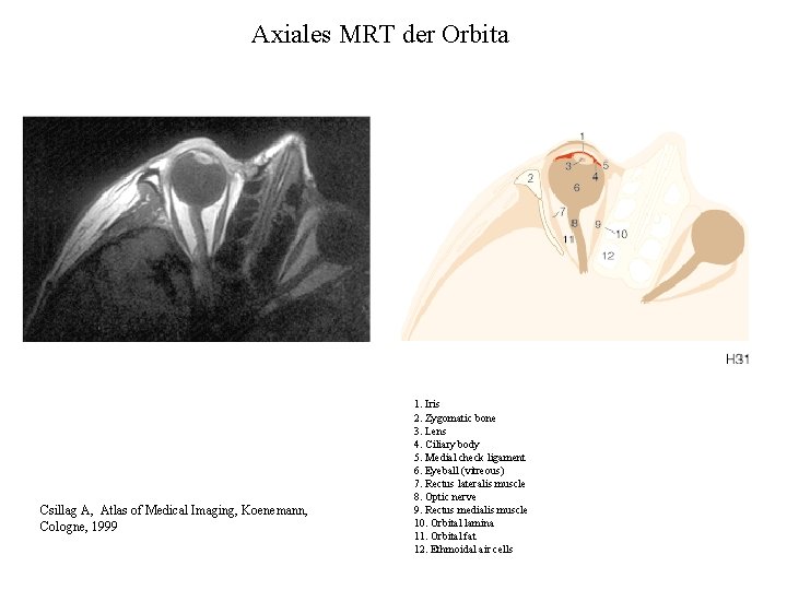 Axiales MRT der Orbita Csillag A, Atlas of Medical Imaging, Koenemann, Cologne, 1999 1. Axiales MRT der Orbita Csillag A, Atlas of Medical Imaging, Koenemann, Cologne, 1999 1.