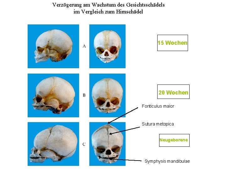 Verzögerung am Wachstum des Gesichtsschädels im Vergleich zum Hirnschädel 15 Wochen 20 Wochen Fonticulus