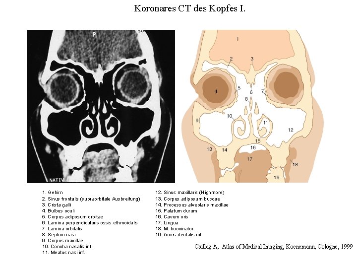 Koronares CT des Kopfes I. 1. Gehirn 2. Sinus frontalis (supraorbitale Ausbreitung) 3. Crista