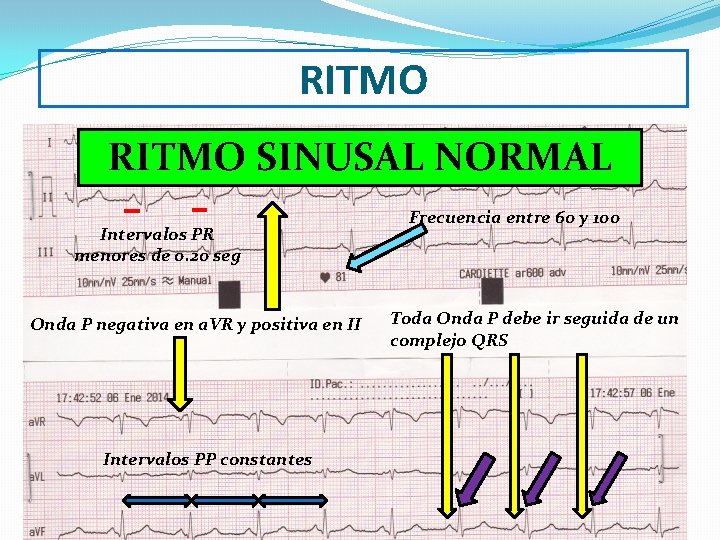 RITMO SINUSAL NORMAL Intervalos PR menores de 0. 20 seg Onda P negativa en