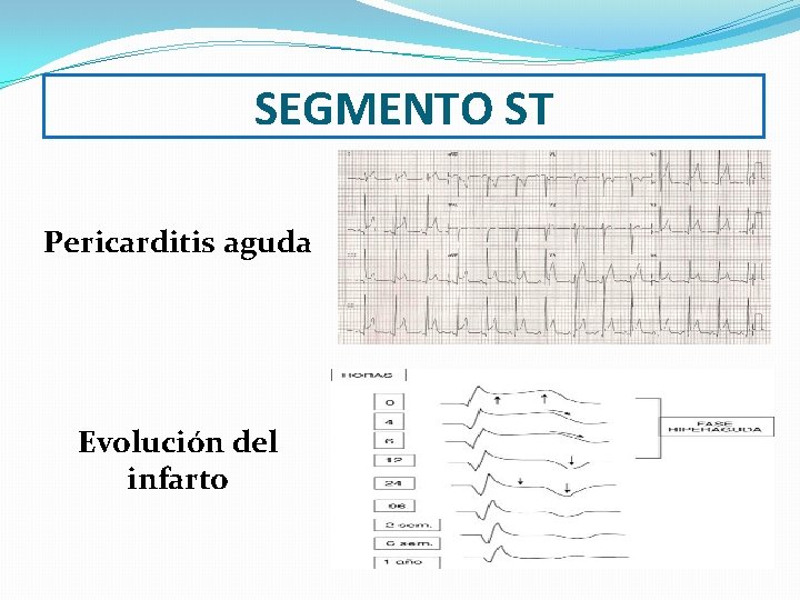 SEGMENTO ST Pericarditis aguda Evolución del infarto 