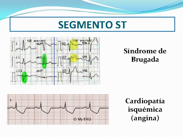 SEGMENTO ST Síndrome de Brugada Cardiopatía isquémica (angina) 