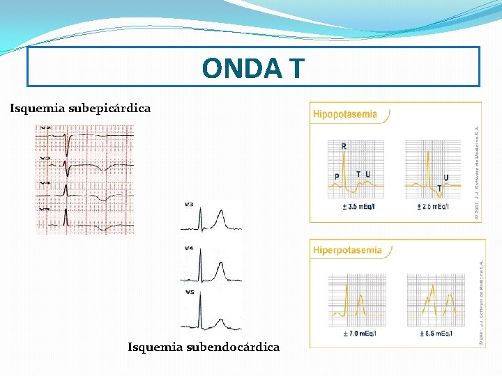 ONDA T Isquemia subepicárdica Isquemia subendocárdica 