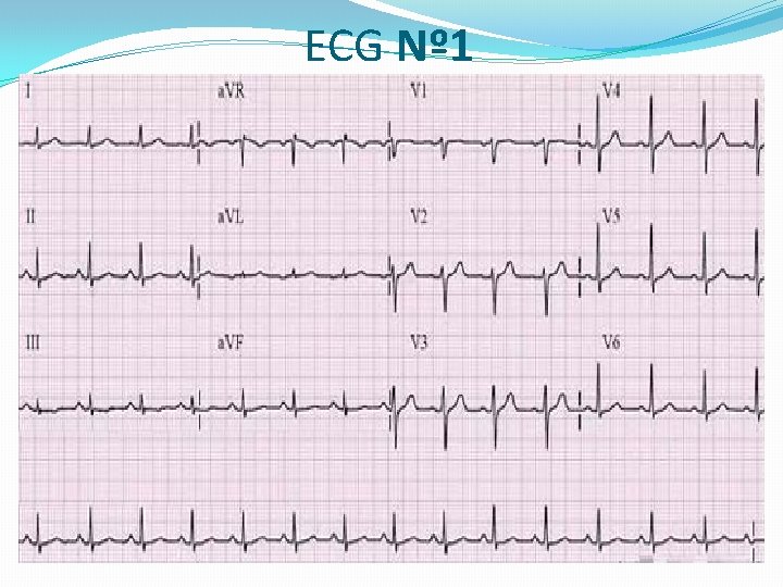 ECG Nº 1 