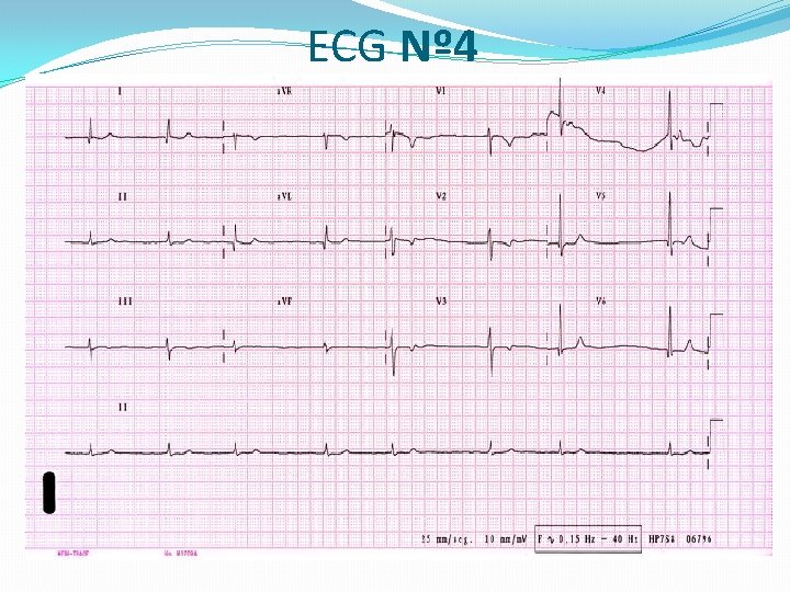 ECG Nº 4 