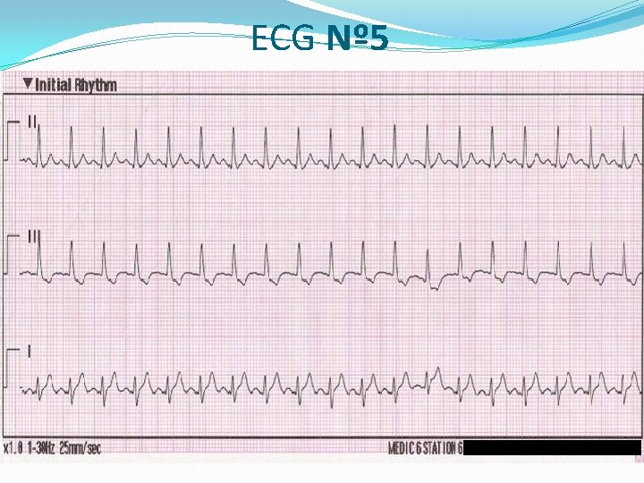 ECG Nº 5 