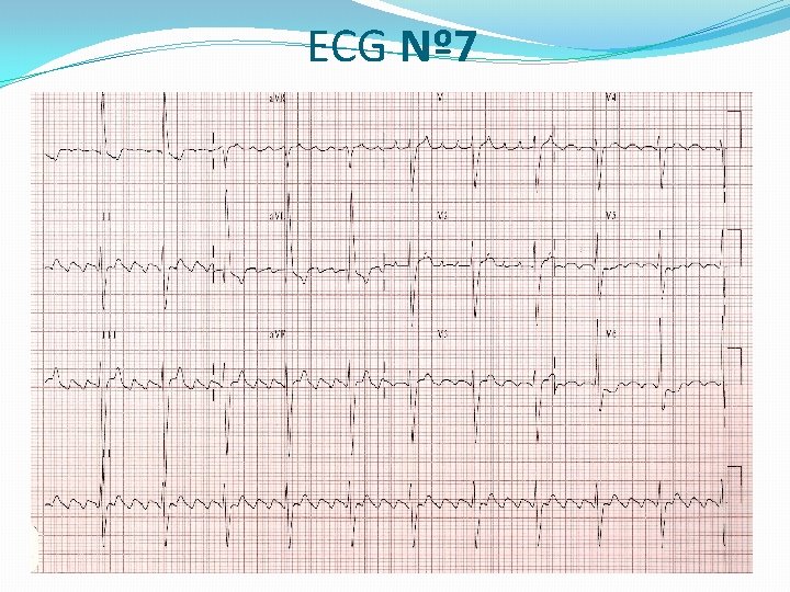 ECG Nº 7 