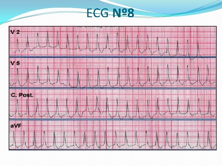 ECG Nº 8 