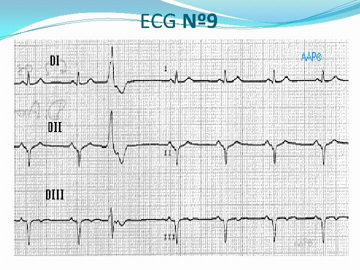 ECG Nº 9 