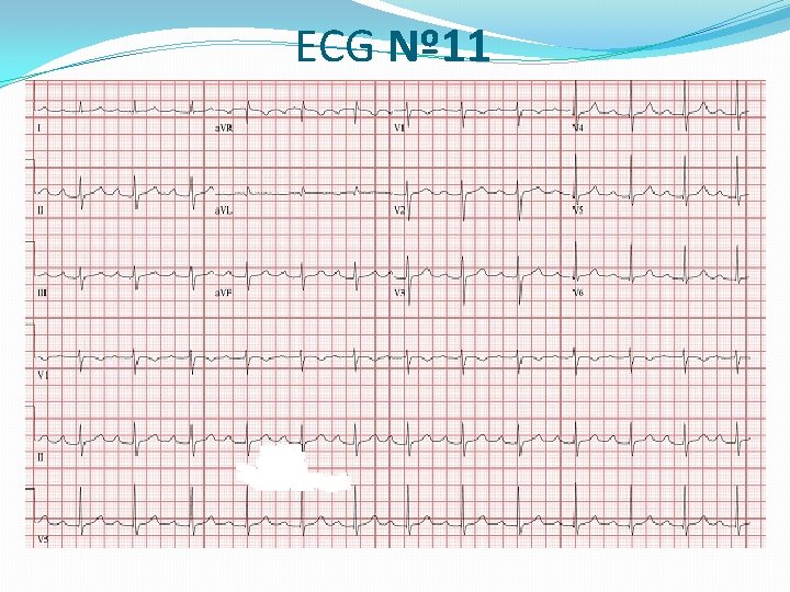 ECG Nº 11 