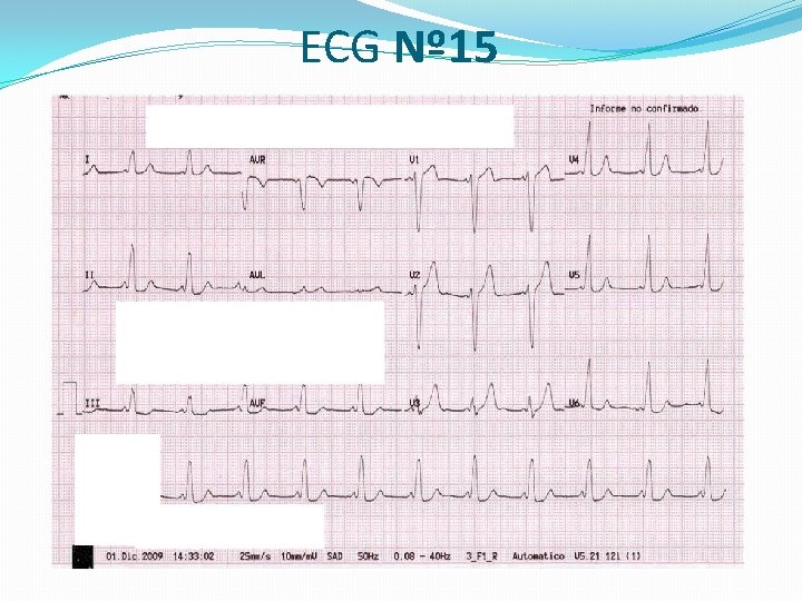 ECG Nº 15 