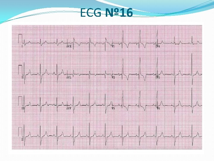 ECG Nº 16 