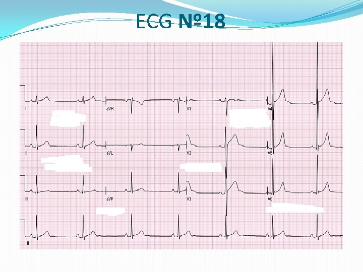 ECG Nº 18 