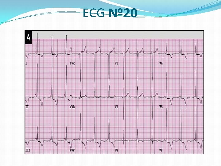 ECG Nº 20 