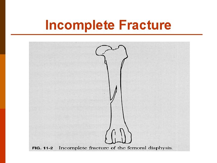 Incomplete Fracture 