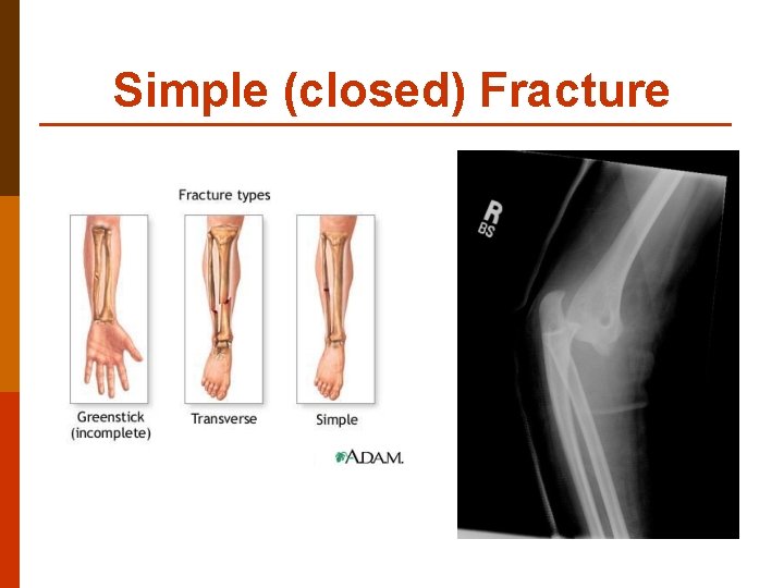 Simple (closed) Fracture 