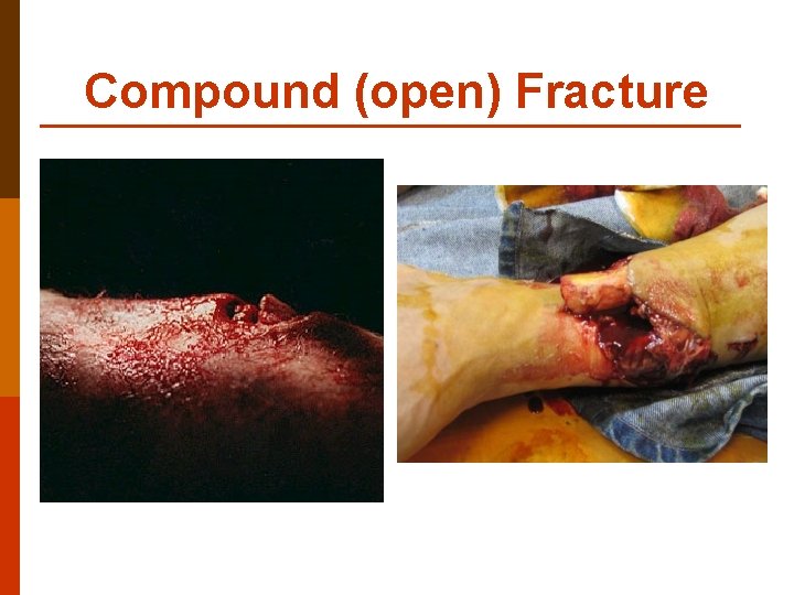 Compound (open) Fracture 