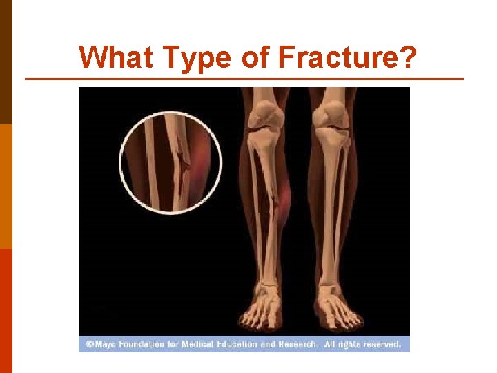 What Type of Fracture? 