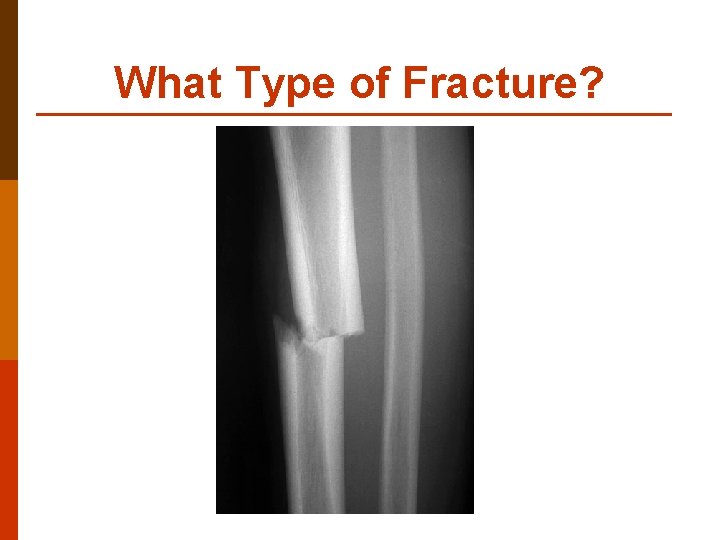 What Type of Fracture? 