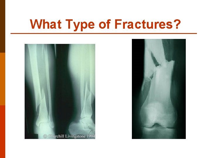 What Type of Fractures? 