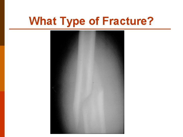 What Type of Fracture? 