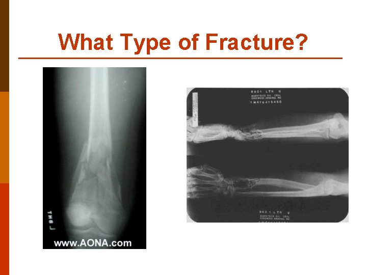 What Type of Fracture? 
