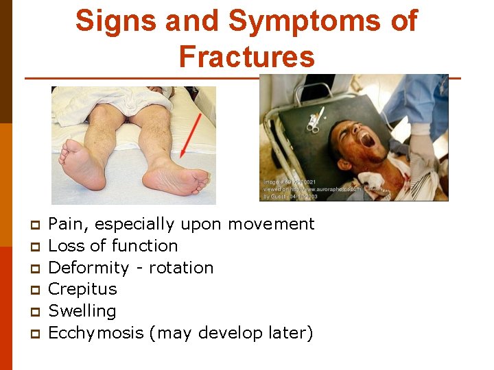 Signs and Symptoms of Fractures p p p Pain, especially upon movement Loss of