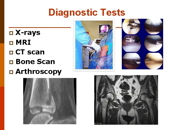 Diagnostic Tests X-rays p MRI p CT scan p Bone Scan p Arthroscopy p