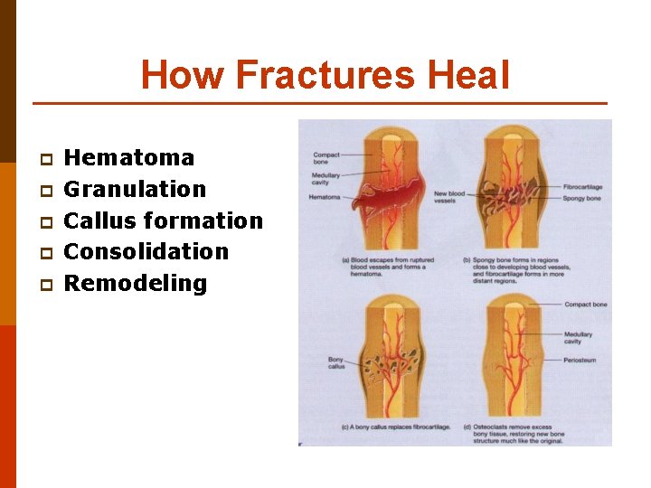 How Fractures Heal p p p Hematoma Granulation Callus formation Consolidation Remodeling 