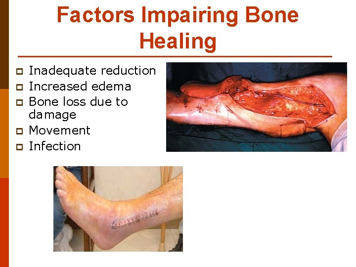 Factors Impairing Bone Healing p p p Inadequate reduction Increased edema Bone loss due