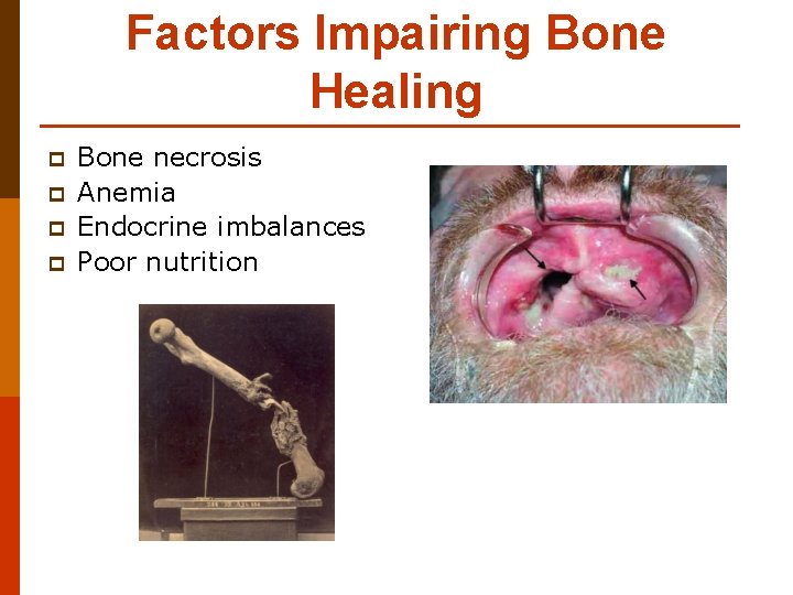 Factors Impairing Bone Healing p p Bone necrosis Anemia Endocrine imbalances Poor nutrition 