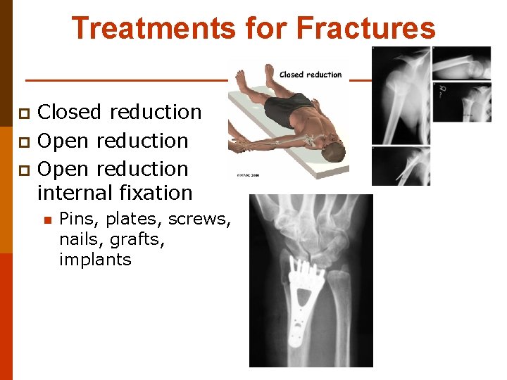 Treatments for Fractures Closed reduction p Open reduction internal fixation p n Pins, plates,