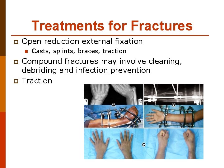 Treatments for Fractures p Open reduction external fixation n p p Casts, splints, braces,