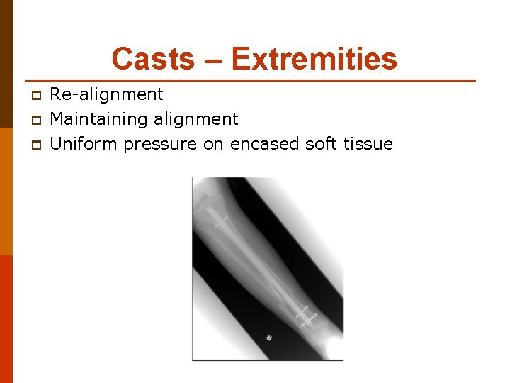 Casts – Extremities p p p Re-alignment Maintaining alignment Uniform pressure on encased soft