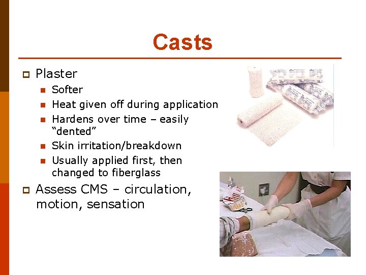 Casts p Plaster n n n p Softer Heat given off during application Hardens