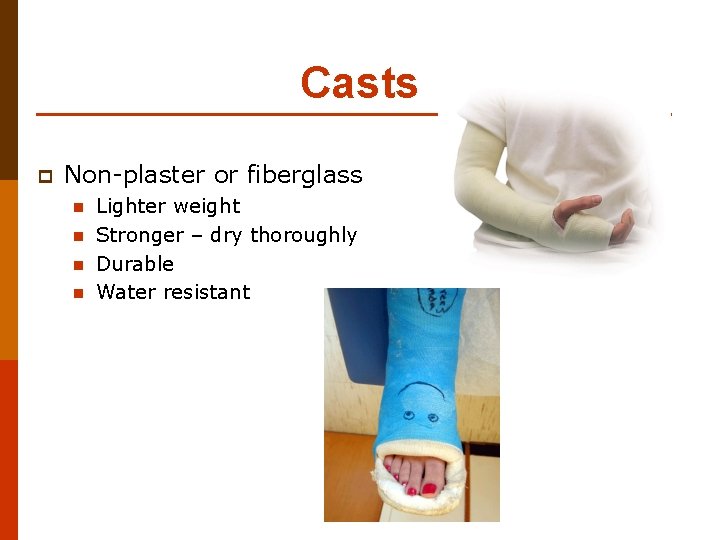 Casts p Non-plaster or fiberglass n n Lighter weight Stronger – dry thoroughly Durable