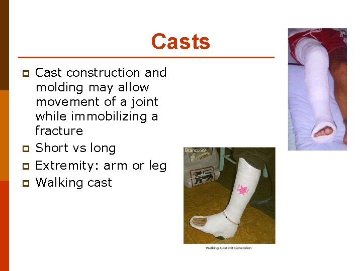 Casts p p Cast construction and molding may allow movement of a joint while