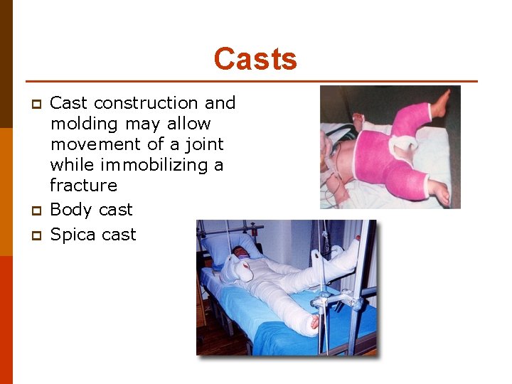 Casts p p p Cast construction and molding may allow movement of a joint