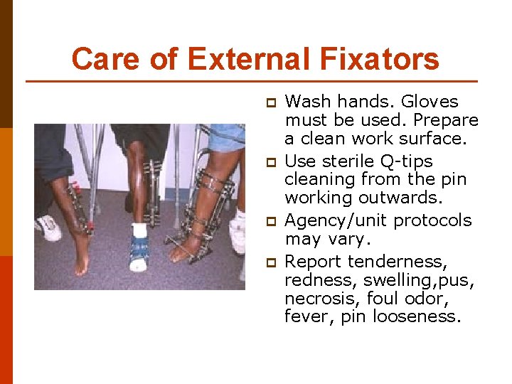 Care of External Fixators p p Wash hands. Gloves must be used. Prepare a