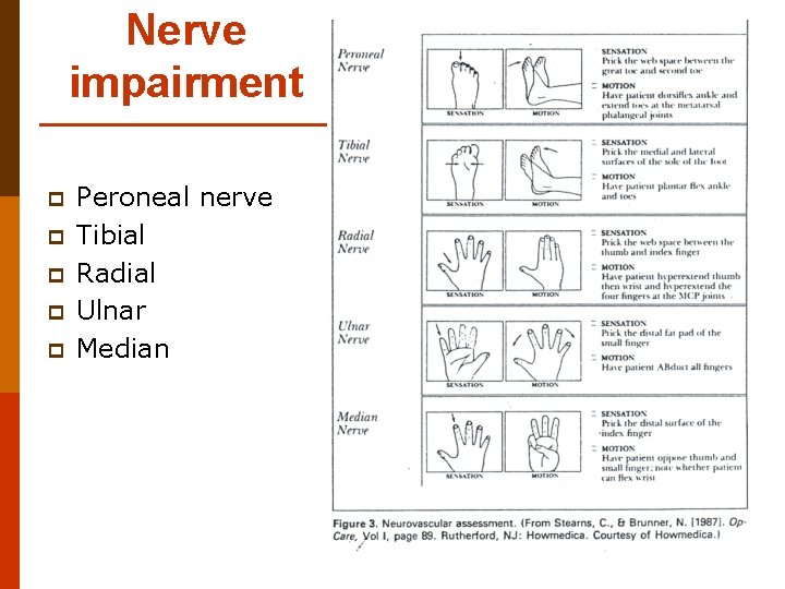 Nerve impairment p p p Peroneal nerve Tibial Radial Ulnar Median 