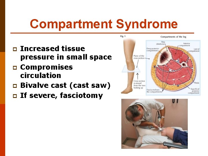 Compartment Syndrome p p Increased tissue pressure in small space Compromises circulation Bivalve cast