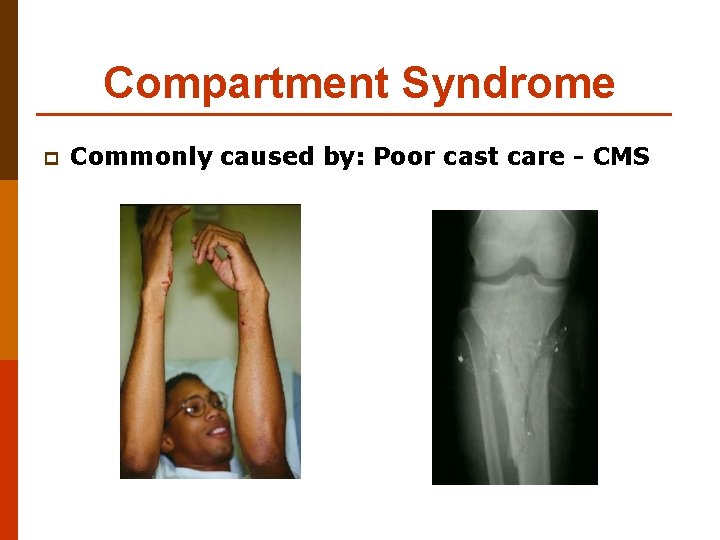 Compartment Syndrome p Commonly caused by: Poor cast care - CMS 