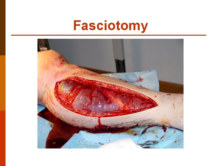 Fasciotomy 