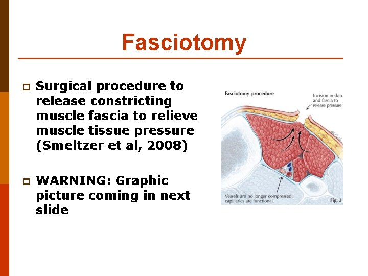 Fasciotomy p Surgical procedure to release constricting muscle fascia to relieve muscle tissue pressure