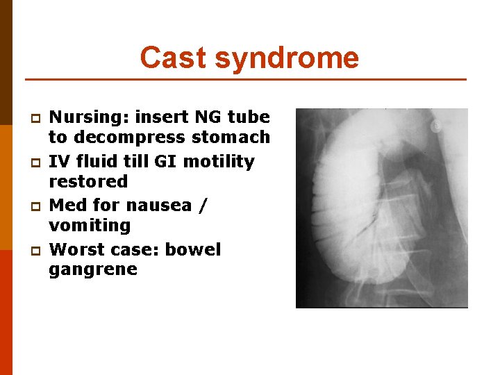 Cast syndrome p p Nursing: insert NG tube to decompress stomach IV fluid till